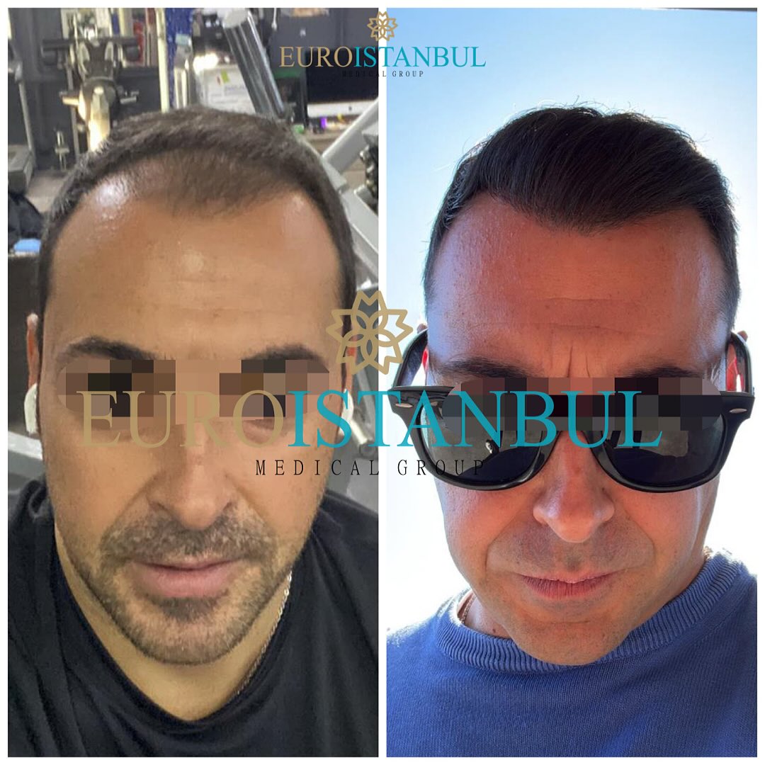 Risultato trapianto capelli FUE Zaffiro a 12 mesi