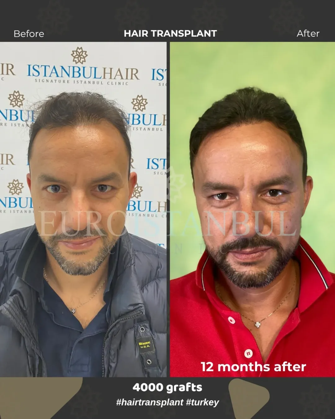 Risultato trapianto capelli prima e dopo 12 mesi